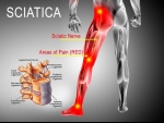 3 Simple Stretches for Sciatica Pain Relief