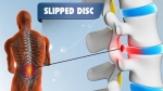 3 Telltale Signs You Have a Slipped or Bulging Disc