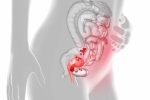 6 Telltale Symptoms of Endometriosis