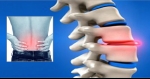 Can Herniated Discs Heal on Their Own?