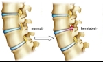 Causes and Risk Factors of Lumbar Herniated Disc