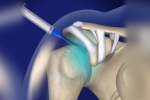 Chronic Pain: Joint Injections