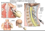 Chronic Pain: Trigger Point Injections