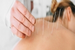 CMS Looking at Acupuncture for Back Pain