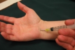 Corticosteroid Injections for Carpal Tunnel Syndrome