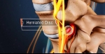 Diagnosing a Lumbar Herniated Disc