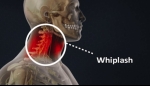 Diagnosing Whiplash