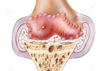 Early Symptoms of Osteoarthritis