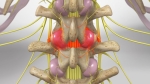 Facet And Medial Branch Block