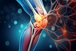 Genicular Nerve Ablation for Knee Pain