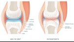 How Genetics May Influence Your Risk for Osteoarthritis