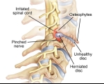 How Long Does a Pinched Nerve Last?