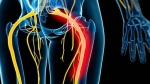 Is Piriformis Syndrome the Same Thing as Sciatica?