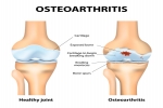 1. Knee Osteoarthritis Symptoms