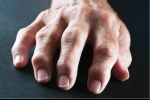 Localized Joint Swelling May Predict Joint Damage in Rheumatoid Arthritis