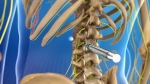 Lumbar Sympathetic Injections