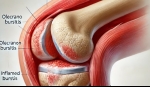 Managing Olecranon Bursitis with Interventional Pain Techniques
