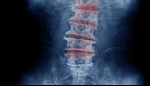 Options for Degenerative Disc Pain