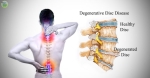 Pain Management: Degenerative Disc Disease (DDD)