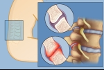 Pain Management: Facet Syndrome