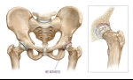 Pain Management: Hip Arthritis