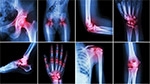 Pain Management: Joint Arthritis