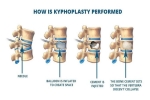 Pain Management: Kyphoplasty