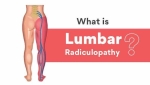 Pain Management: Lumbar Radiculopathy