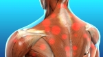 Pain Management: Myofascial Pain Syndrome