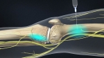 Pain Management: Nerve Block