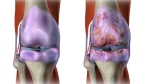 Pain Management: Osteoarthritis