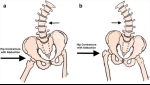 Pain Management: Pelvic Unleveling