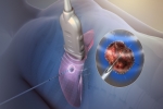 Pain Management: Radiofrequency Ablation