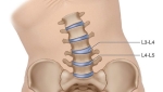 Pain Management: Segmental Dysfunction