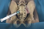Pain Management: SI Joint Injection
