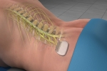 Pain Management: Spinal Cord Stimulation