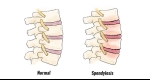 Pain Management: Spondylosis