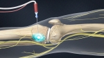 Radiofrequency Neurotomy Genicular Nerve Block