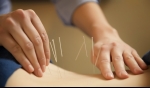 Relieving Pain With Acupuncture