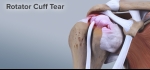 Rotator Cuff Tear