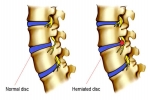 Signs of a Herniated Disc in the Lumbar and Cervical Spine