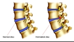 Signs of a Herniated Disc in the Lumbar and Cervical Spine