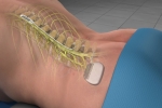 Spinal Cord Stimulation May Be the Answer to Dealing With Chronic Back Pain