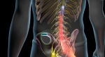 Spinal Cord Stimulators Offer Drug-Free Relief from Chronic Back Pain