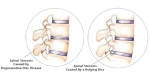 Spinal Stenosis Symptoms and Diagnosis