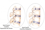 Spinal Stenosis Treatments