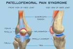Sports Medicine: Patellofemoral Pain Syndrome