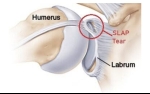 Sports Medicine: Shoulder Labrum Tears