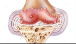 Stages of Knee Osteoarthritis