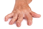 Stem Cell Therapy For Rheumatoid Arthritis